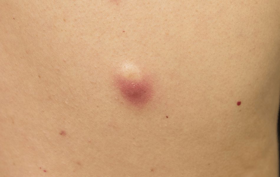 粉瘤とは？できやすい人の特徴はある？治療法・予防法なども解説