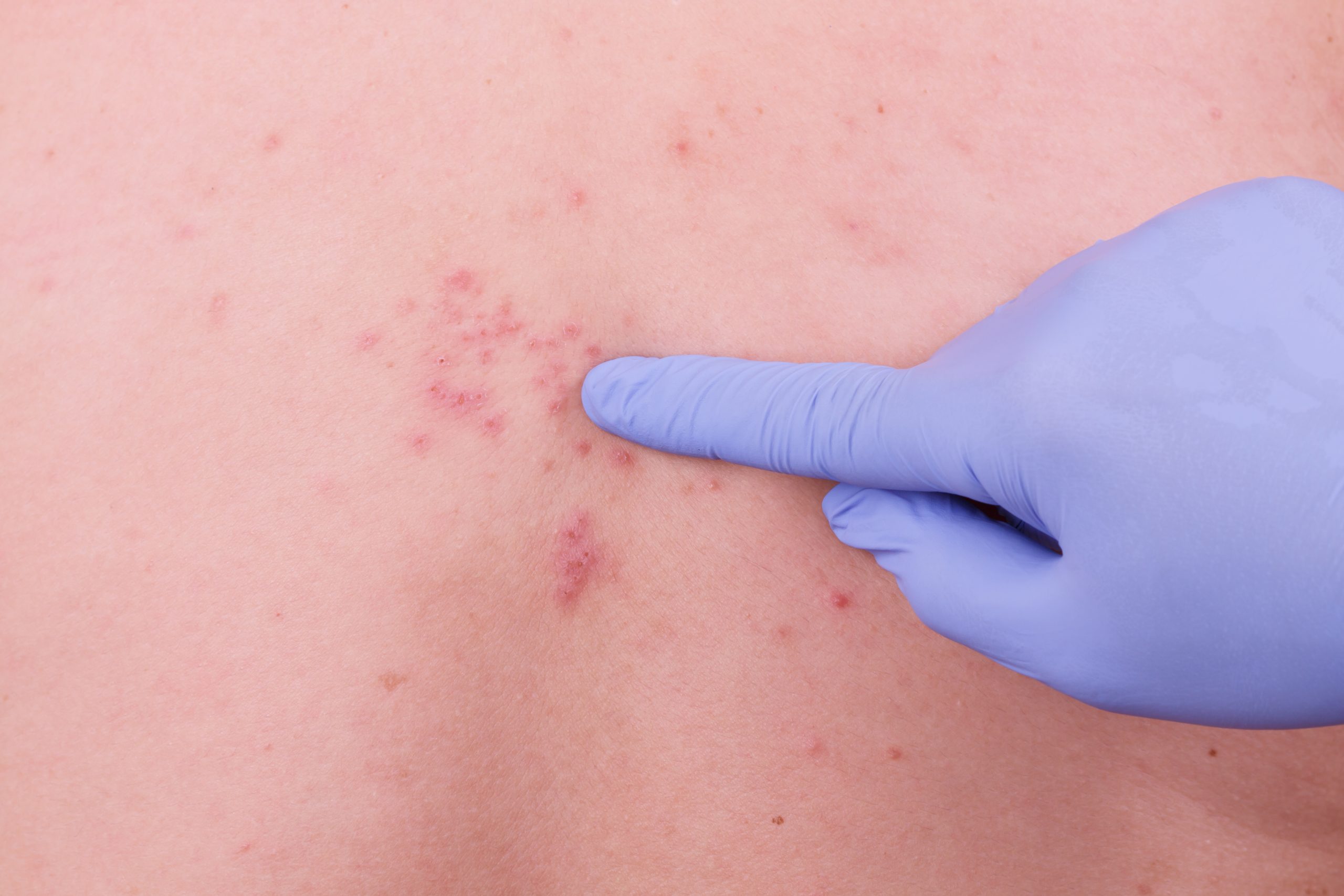 女性が口唇ヘルペスになる原因