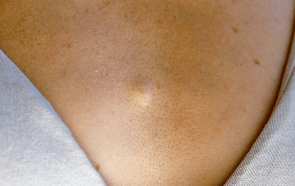 粉瘤の見分け方とは？粉瘤とニキビ・イボ・せつ・脂肪腫・痔ろうの違い