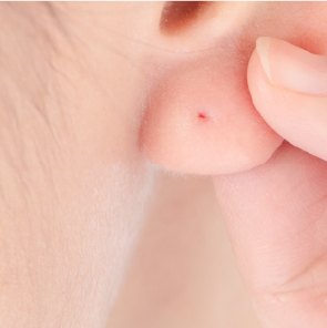 ピアスの穴あけ（ピアッシング）