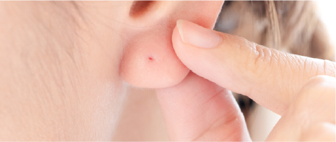 ピアスの穴あけ（ピアッシング）